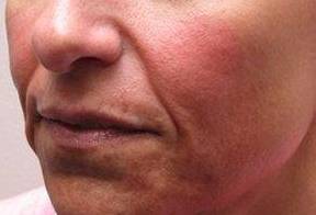 before dermal fillers left angle close up view female patient case 3008