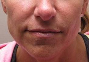 after dermal fillers front close up view female patient case 3008