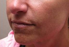 after dermal fillers left angle close up view female patient case 3008