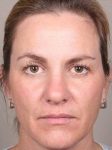 before dermal fillers front view female patient case 3016