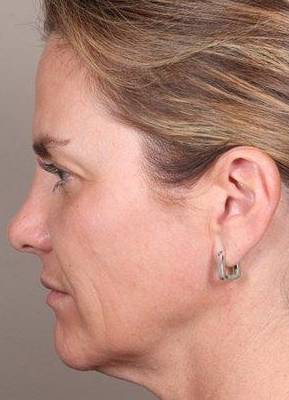 before dermal fillers left side view female patient case 3016