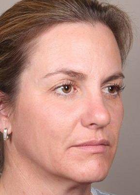 before dermal fillers right angle view female patient case 3016