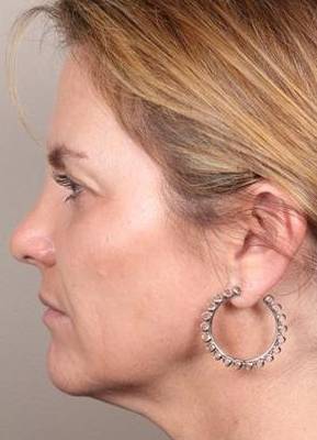 after dermal fillers left side view female patient case 3016