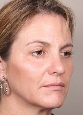 after dermal fillers right angle view female patient case 3016