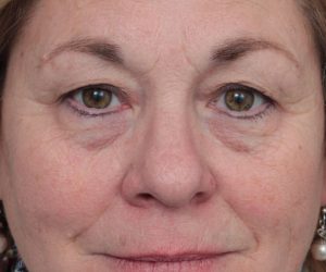Before Eyelid Lift Female Patient Front Angle View Case 2897