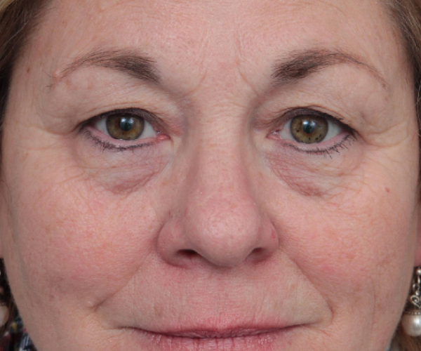 Before Eyelid Lift Female Patient Front Angle View Case 2897