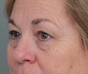 Before Eyelid Lift Female Patient Diagonal Angle View Case 2897