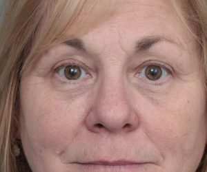 After Eyelid Lift Female Patient Front Angle View Case 2897