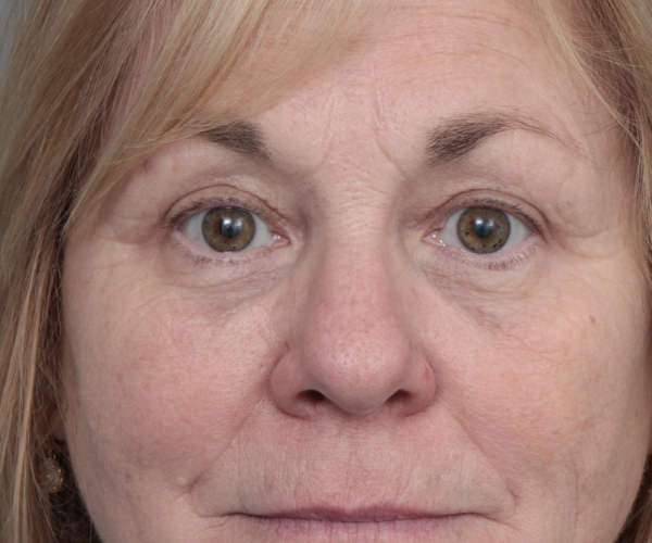 After Eyelid Lift Female Patient Front Angle View Case 2897