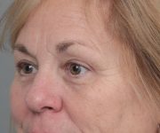 After Eyelid Lift Female Patient Diagonal Angle View Case 2897