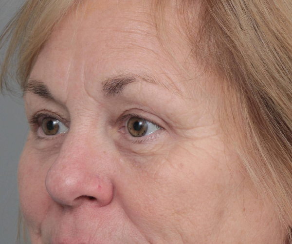 After Eyelid Lift Female Patient Diagonal Angle View Case 2897