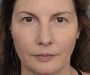 Before Eyelid Lift Female Patient Front Angle View Case 2902
