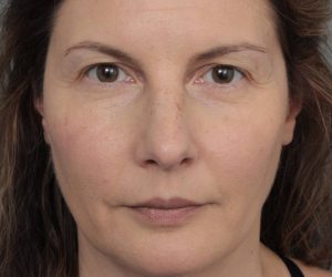 Before Eyelid Lift Female Patient Front Angle View Case 2902