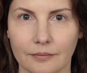 After Eyelid Lift Female Patient Front Angle View Case 2902