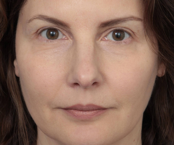 After Eyelid Lift Female Patient Front Angle View Case 2902