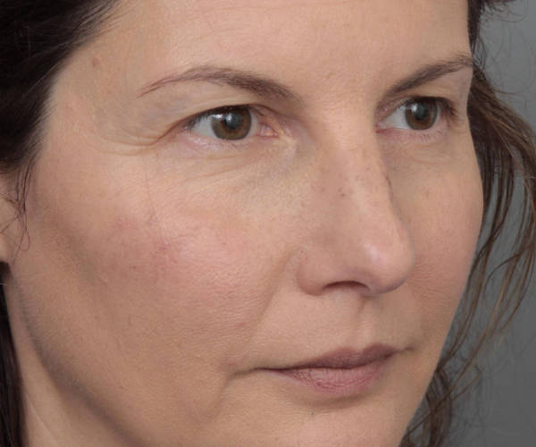 Before Eyelid Lift Female Patient Diagonal Angle View Case 2902