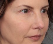After Eyelid Lift Female Patient Diagonal Angle View Case 2902