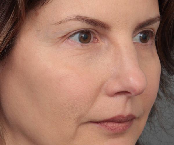 After Eyelid Lift Female Patient Diagonal Angle View Case 2902