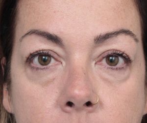 Before Eyelid Lift Female Patient Front Angle View Case 2907