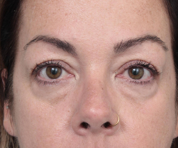 Before Eyelid Lift Female Patient Front Angle View Case 2907