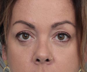 After Eyelid Lift Female Patient Front Angle View Case 2907
