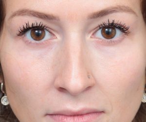 Before Eyelid Lift Female Patient Front Angle View Case 2910