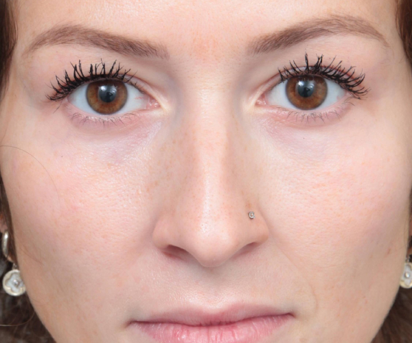 Before Eyelid Lift Female Patient Front Angle View Case 2910