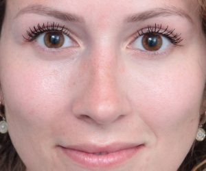 After Eyelid Lift Female Patient Front Angle View Case 2910