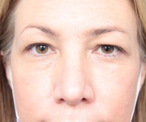 Before Eyelid Lift Female Patient Front Angle View Case 2913