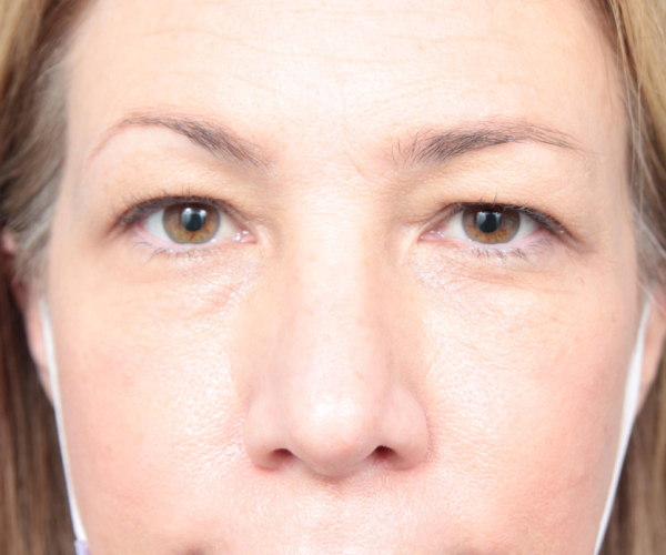 Before Eyelid Lift Female Patient Front Angle View Case 2913