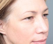 Before Eyelid Lift Female Patient Diagonal Angle View Case 2913
