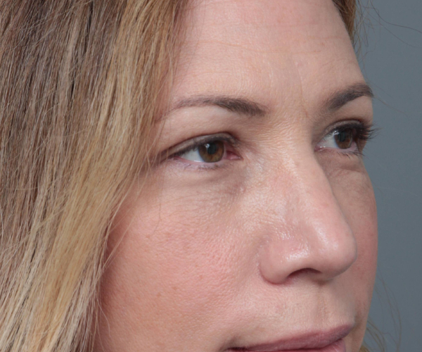 After Eyelid Lift Female Patient Diagonal Angle View Case 2913