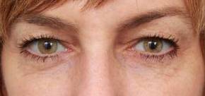 Before Eyelid Lift Female Patient Front Angle View Case 2918