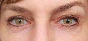 After Eyelid Lift Female Patient Front Angle View Case 2918