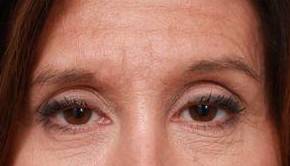 Before Eyelid Lift Female Patient Front Angle View Case 2921