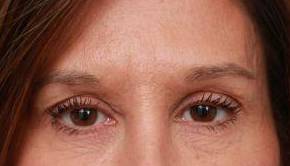 After Eyelid Lift Female Patient Front Angle View Case 2921