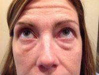 before eyelid lift female patient front view looking up case 2924