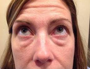 before eyelid lift female patient front view looking up case 2924