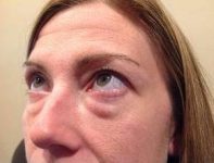 before eyelid lift female patient left angled view looking up case 2924