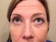 after eyelid lift female patient front view looking up case 2924