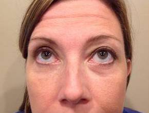 after eyelid lift female patient front view looking up case 2924