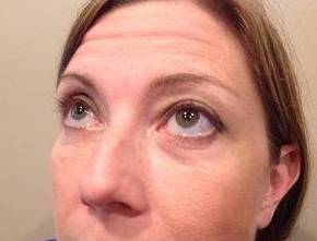 after eyelid lift female patient left angled view looking up case 2924
