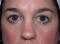 before eyelid lift female patient front view case 2929
