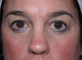 before eyelid lift female patient front view case 2929