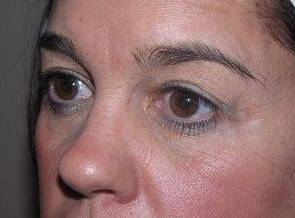 before eyelid lift female patient left angled view case 2929