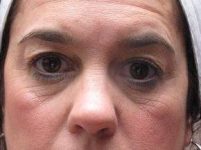before eyelid lift female patient front view case 2929