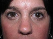 after eyelid lift female patient front view case 2929