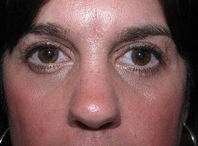 after eyelid lift female patient front view case 2929