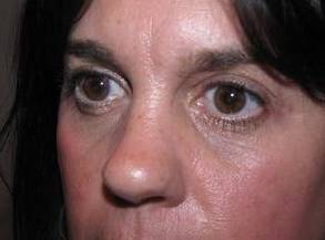 after eyelid lift female patient left angled view case 2929