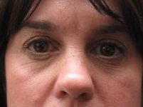 after eyelid lift female patient front view case 2929